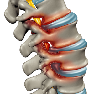 Degenerative Disc Disease