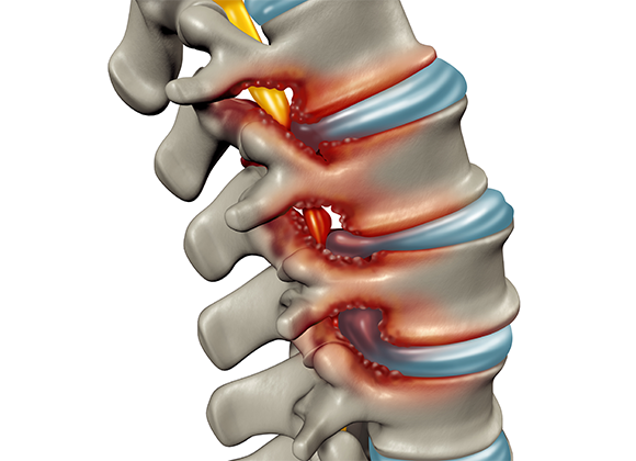 Degenerative Disc Disease