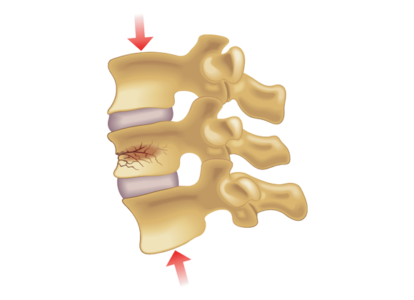 Compression Fracture