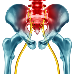 Sciatica Pain