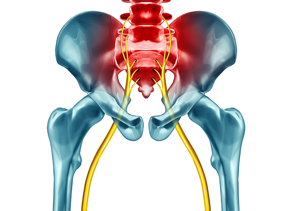 Sciatica Pain