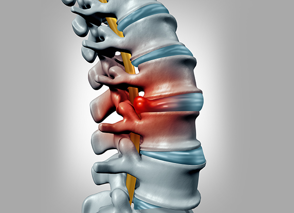 Herniated Disc Disease