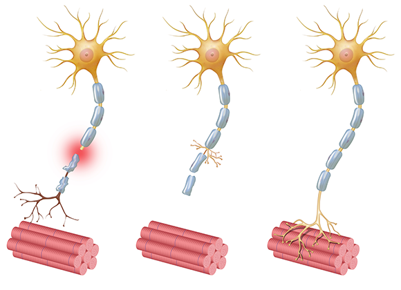 Neuropathy