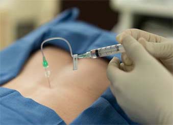 Epidural Injections in New York